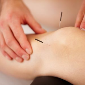 Acupuncture Treatment on knee