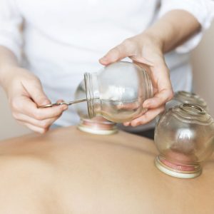 Fire cupping treatment on back